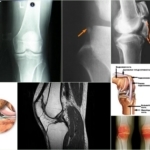 Ligamentoz Knie - äußere Merkmale der Pathologie