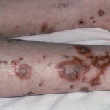 Acute, purulent surgical infection
