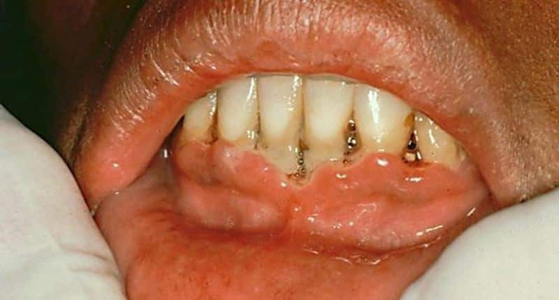 martwicze wrzodziejące zapalenie jamy ustnej Vincent