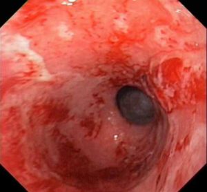 Gastritis pada manusia