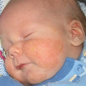 Ruwe huid van het kind: Oorzaken en aanbevelingen