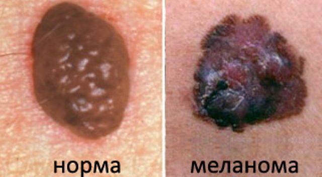 tumor kože