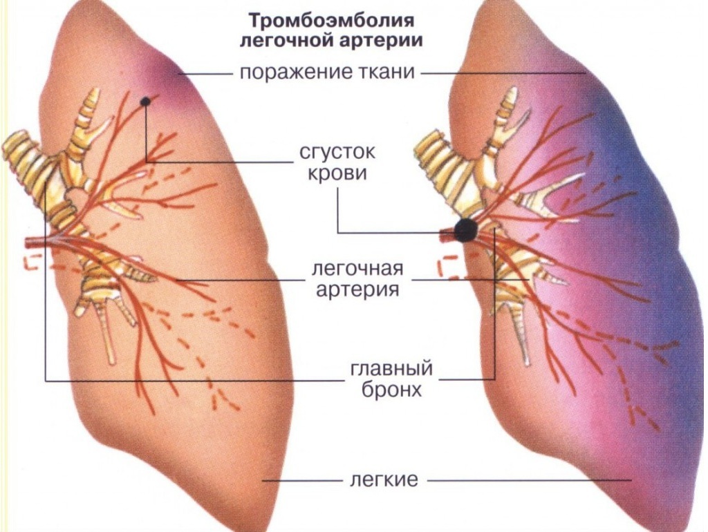 Causes of development of pulmonary embolism