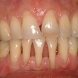 Parodontna bolest: simptomi, liječenje