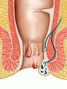 Hemoroīdu mantojums