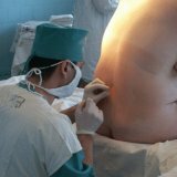 Tehnika spinalne anestezije