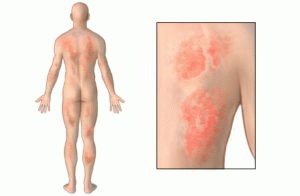 Alergi obat
