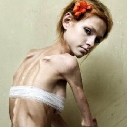 Anorexia: oorzaken, fasen en symptomen
