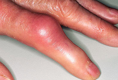 Asymmetrische Psoriasis-Arthritis