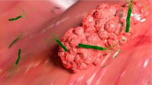 Helicobacter pylori in the stomach