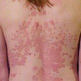 Medicines for psoriasis