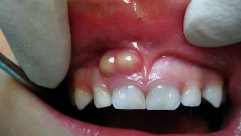 Geschwür auf dem Zahnfleisch: das Foto, was zu behandeln zu tun