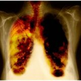 Treatment of lung cancer, symptoms