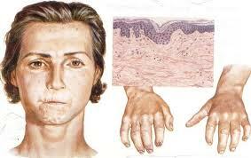 Diffuse scleroderma