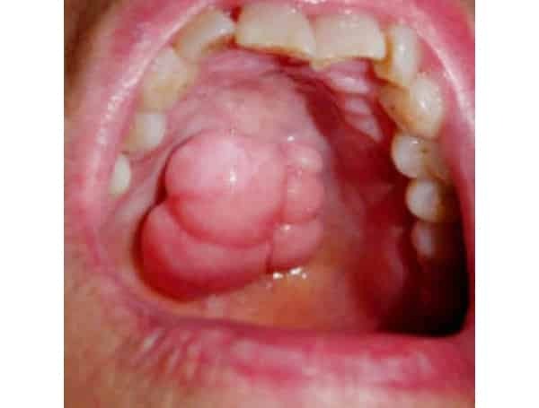 coceira palato superior inflamada da boca do que tratar as causas do que fazer