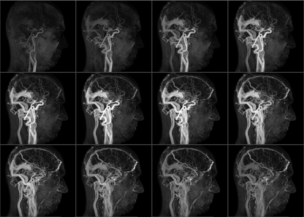 Компјутерска томографија мозга: индикације, контраиндикације, и варијације