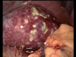 Empyeem van het pathologische orgaan