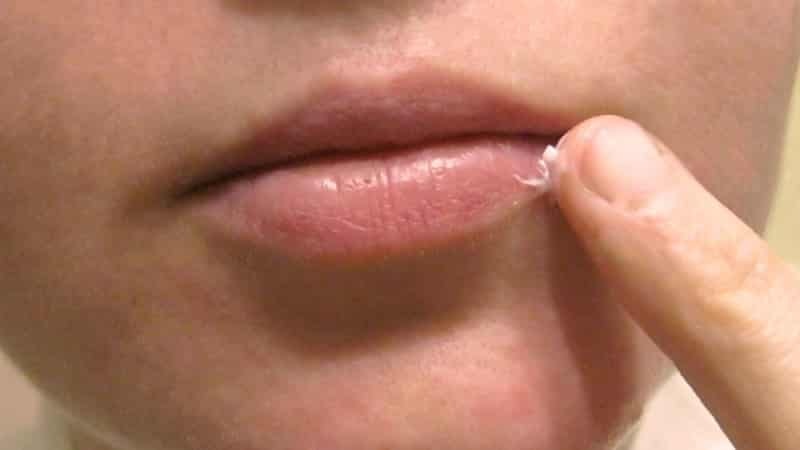 Medikamente für Herpes auf den Lippen