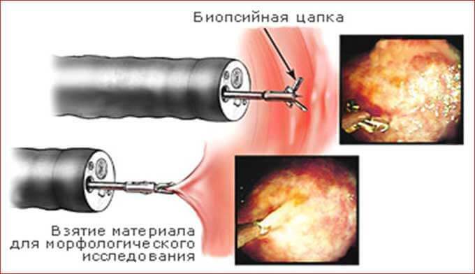 , Biopsia uterina