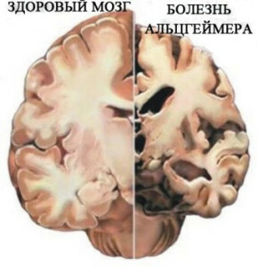 Tervisliku ja Alzheimeri tõvega patsiendi aju võrdlus