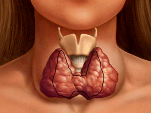 Tanda-tanda pertama dari penyakit tiroid
