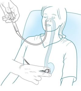 Gastric lavage