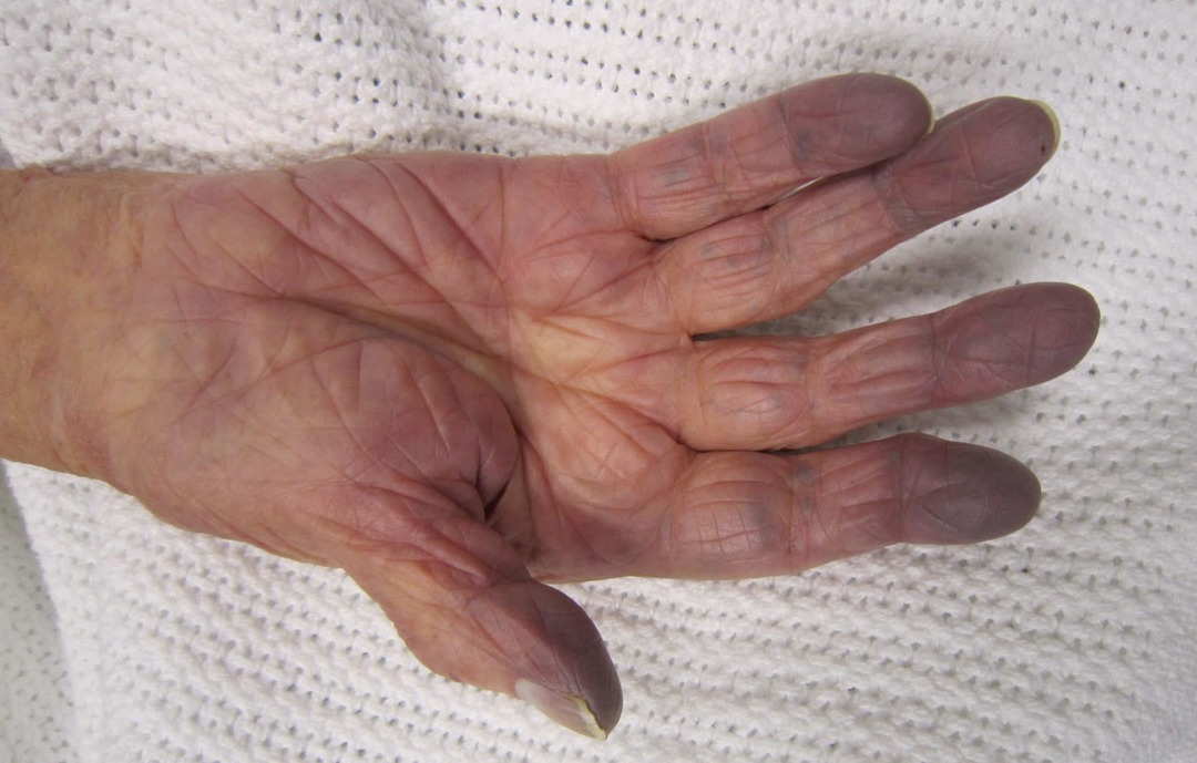 Cyanosis: what is it, causes, symptoms, photos, treatment