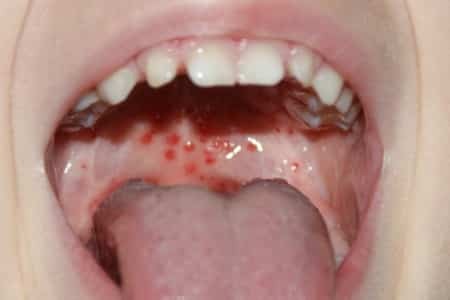 titik merah di langit pada anak di mulut