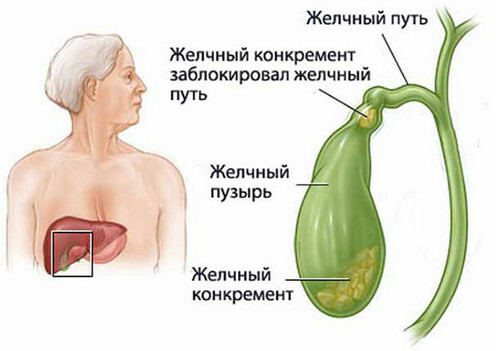 Stones-in-the-gall-bladder