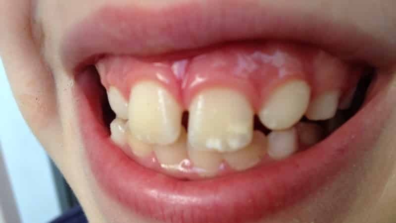 vita fläckar på tandköttet hos vuxna