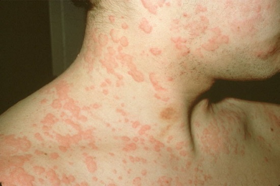 Alergia a cítricos: sintomas e sinais (foto), tratamento
