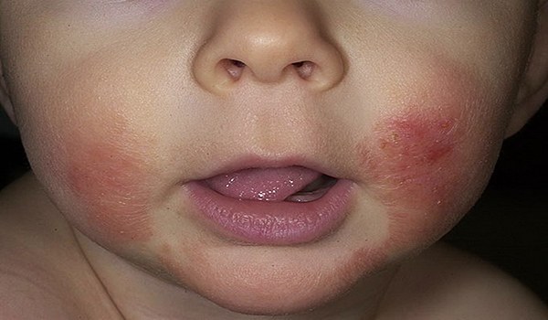 atopijski dermatitis pri otroku