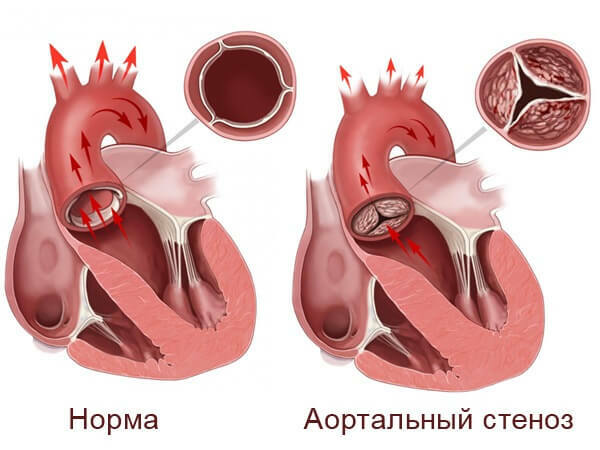 aortastenose