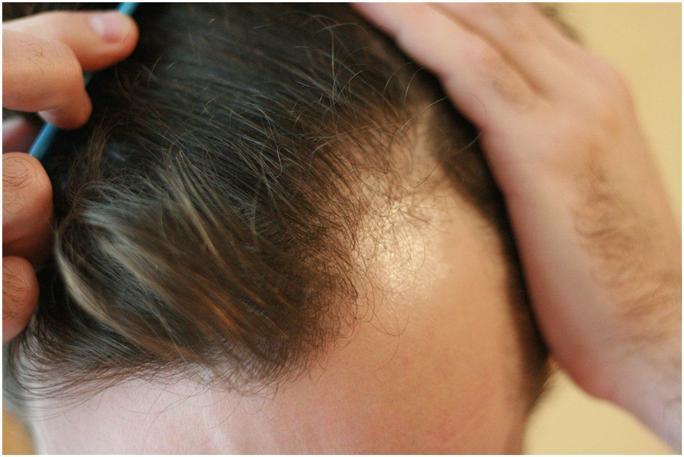 Kalju laastarit ja otsan hiustenlähtö miehillä: hoidot