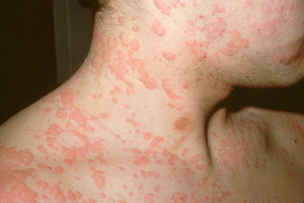 alergijski do smrzavanja 2