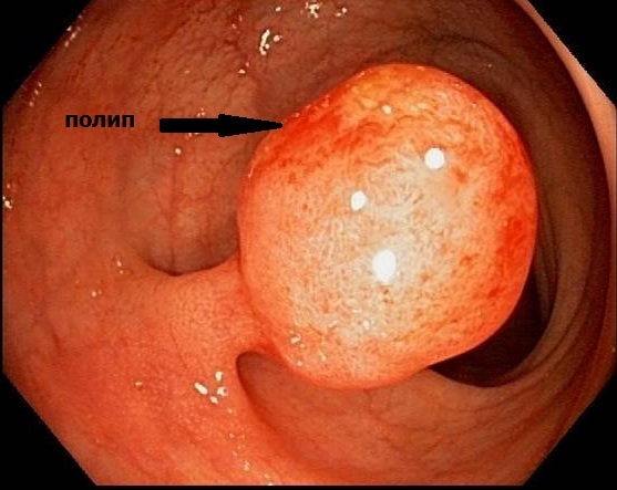 Diagnóstico de pólipos intestinais