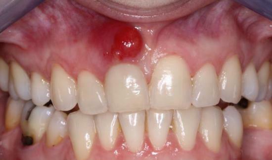 Fistel in dem Zahnfleisch auf dem Foto.Fistel Behandlung