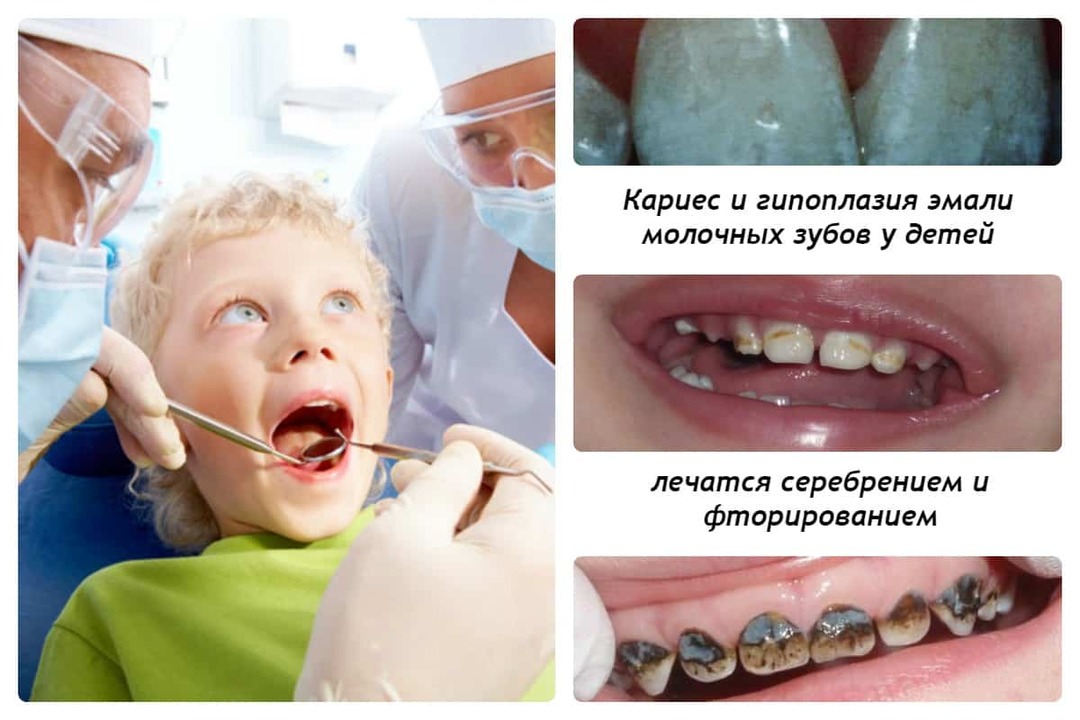 Zašto djeca pocrne mliječne zube i što učiniti kako bi se vaše dijete