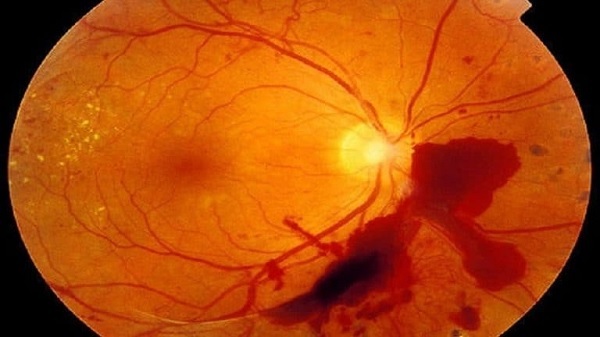 Warum gibt es eine Hämorrhagie im Auge