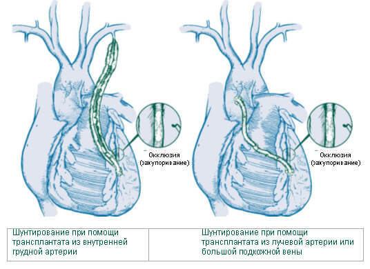 artéria coronária enxerto de bypass