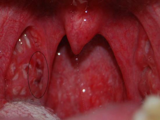 Ulcers in the throat - treatment methods