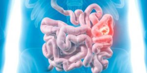 Small intestine tumor