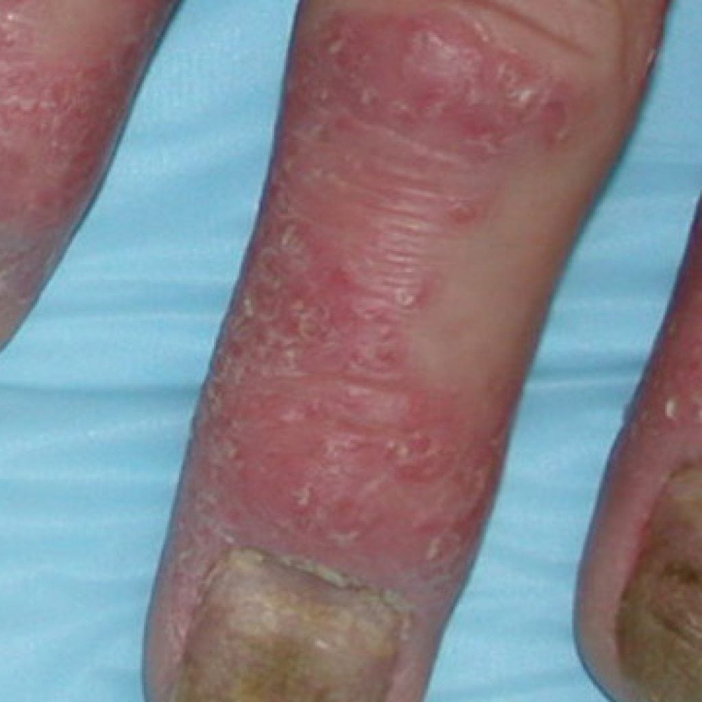 Arthrite psoriasique: symptômes, traitement, photo