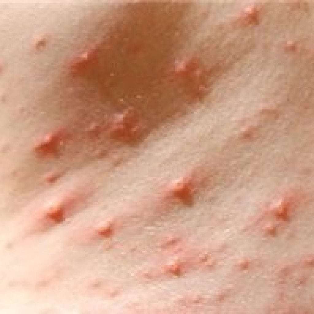 How does chickenpox begin in children, the first signs, photos, treatment