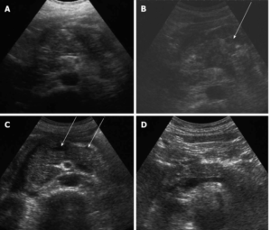 Pancreatitis enfermedad