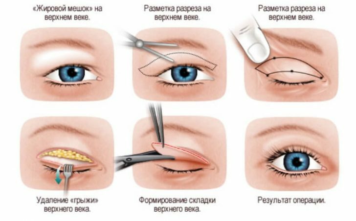 Fatty hernia of the eyelids: causes of appearance and ways of removal