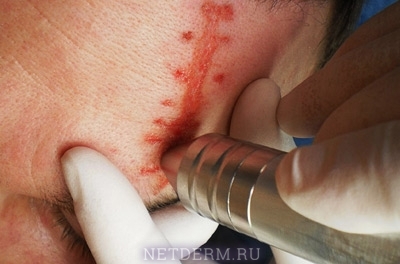 Principle of scars removal by laser