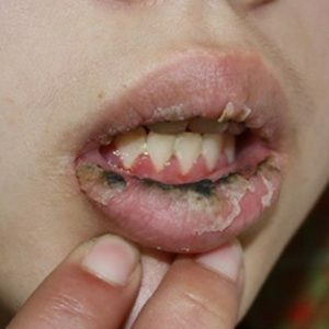How to treat cheilitis on the lips?