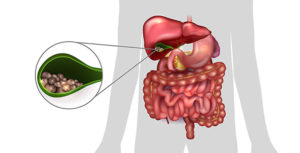 Infectieuze ontsteking in de galblaas