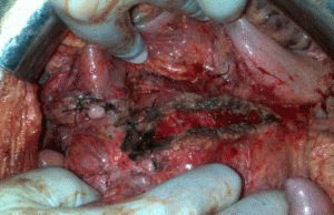 Alcoholische pancreatitis
